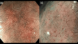 Саркоидоз и ранний рак желудка